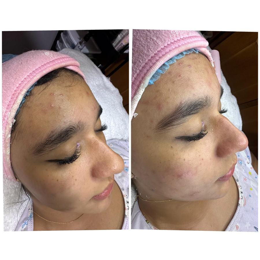 Limpieza facial