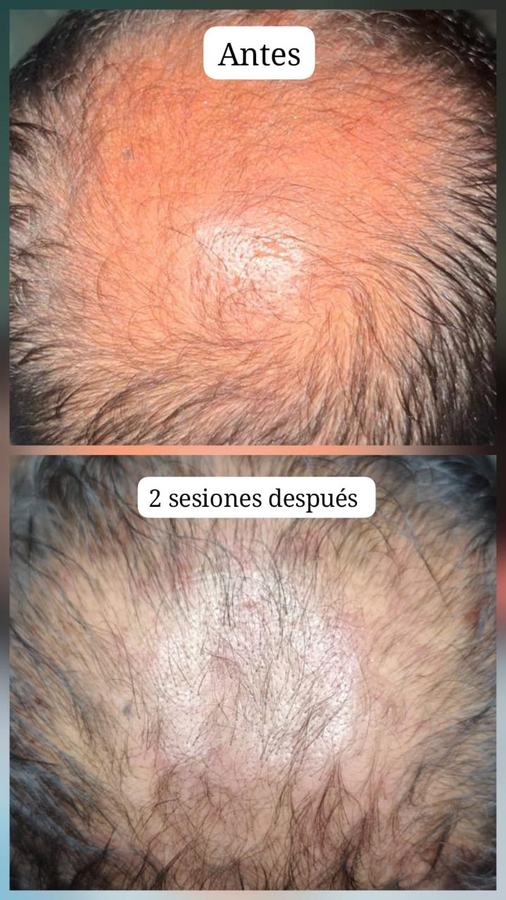 Plasma rico en plaquetas capilar